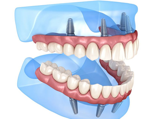 Illustration of all-on-4 implants in upper and lower dental arches