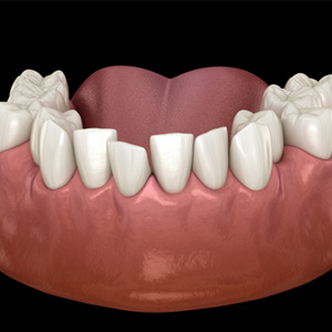 Example of crowded teeth in Garner