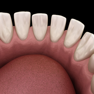 Example of gapped teeth in Garner