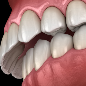 Example of overbite in Garner