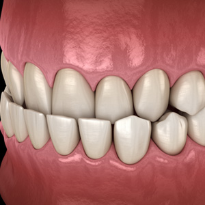 Example of underbite in Garner