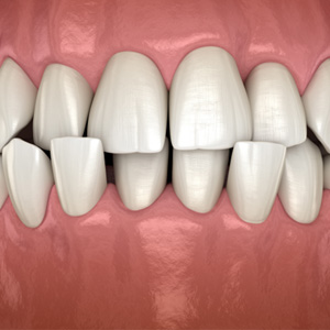 Example of crossbite in Garner