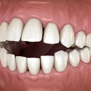 Example of open bite in Garner