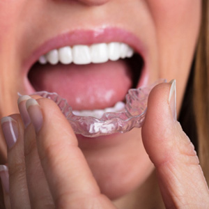 Woman about to put clear aligner in mouth