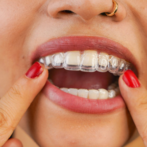 Woman wearing clear aligners on upper teeth