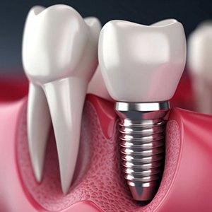 a 3D illustration of a single dental implant