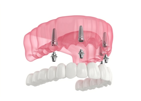 Illustrated denture being fitted over 4 dental implants