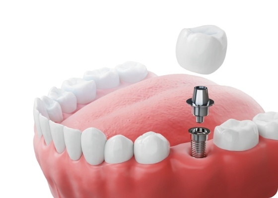 Illustrated dental implant with crown replacing a missing tooth