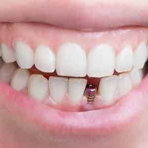 Woman with a dental implant