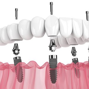 a 3D depiction of All-On-4 dental implants