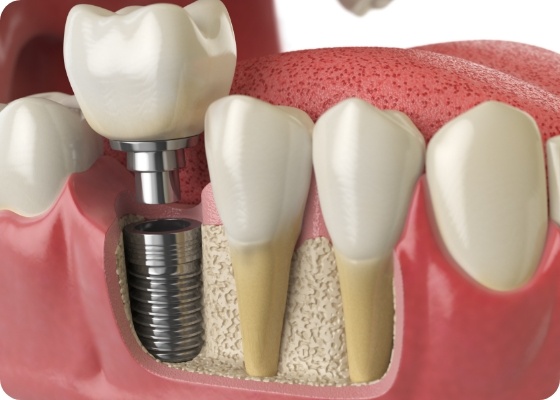 Illustrated dental crown being fitted over a dental implant