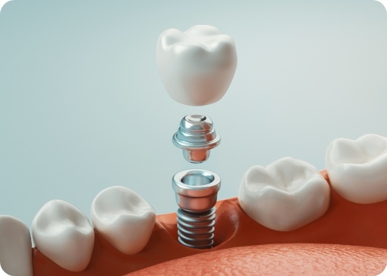 Illustrated dental crown being fitted over a dental implant